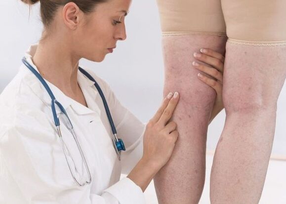 Diagnosis of varicose veins