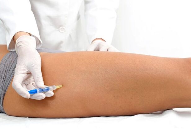 Varice treatment