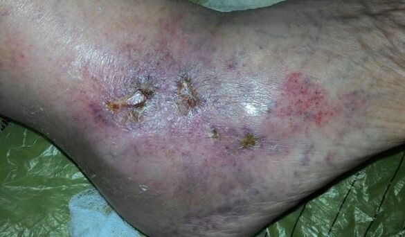 Varicose complications