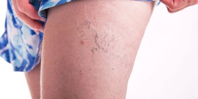 Varices on the leg