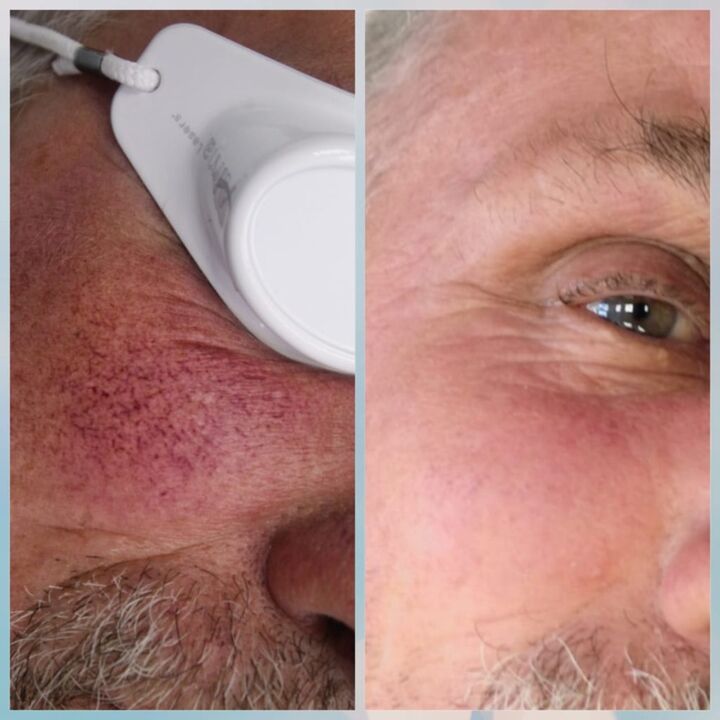Varices on the face