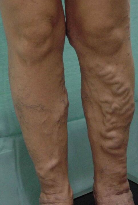Varices on the legs