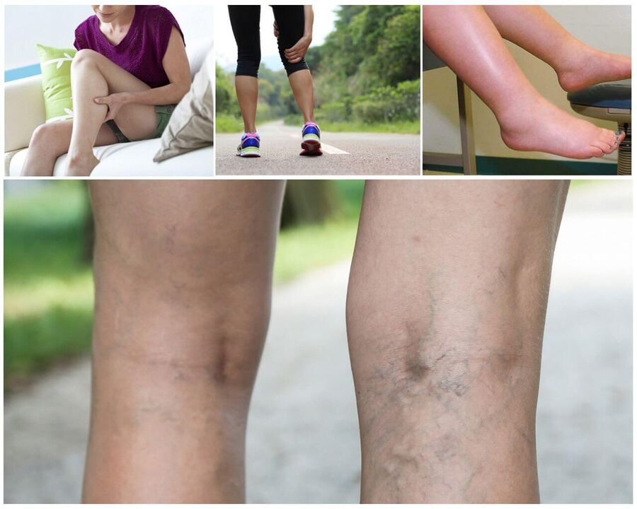 Varicosis beginning