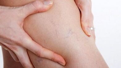 How varicose veins manifest on the legs