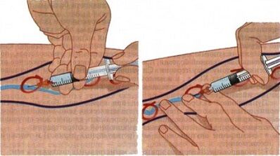 Methods for the treatment of varicose veins