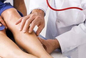 Varices on the legs