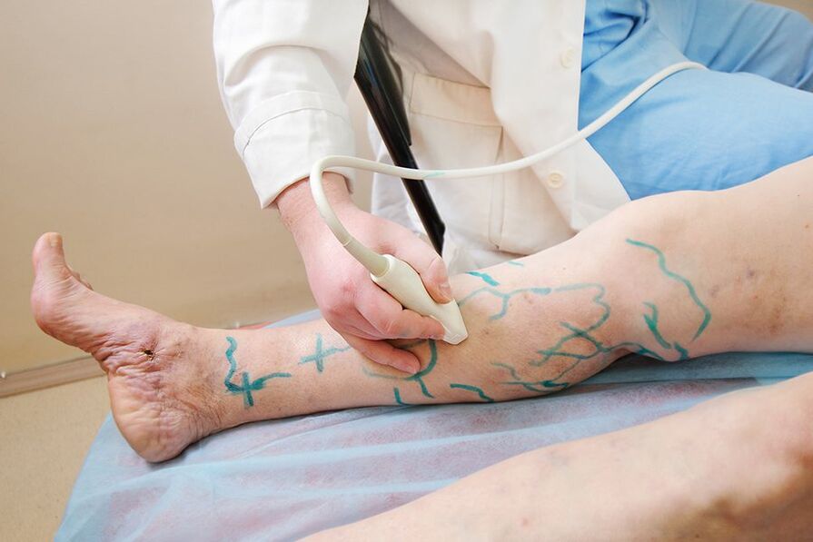 Preparation for miniphlebectomy - marking the perforators of the leg, performing an ultrasound