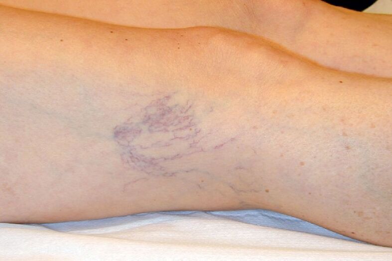 Stage C1 – reticular veins with a diameter of approximately 1 mm