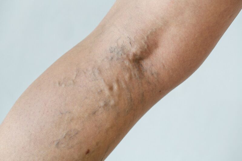 Stage C2 – popliteal varicose veins (Thierry perforator) and reticular veins